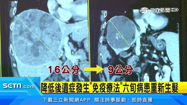 晚期肝癌腫瘤變小 6旬翁成罕見病例|三立inews 晚期肝癌腫瘤變小 6旬翁成罕見病例|三立inews