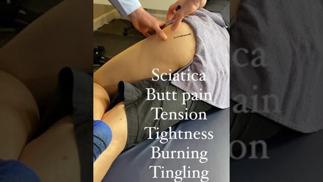 Sciatic nerve entrapment at the deep gluteal space (posterior hip) Sciatic nerve entrapment at the deep gluteal space (posterior hip)