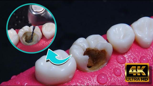 Amazing reconstruction of tooth damaged by caries: endodontics Amazing reconstruction of tooth damaged by caries: endodontics