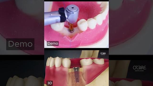 How is dental implant? How is dental implant?