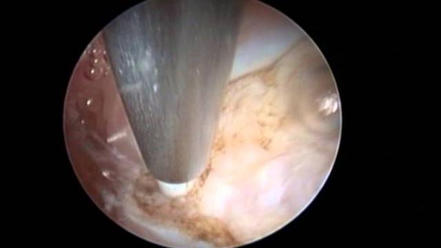 Septum operasyonu Septum operasyonu