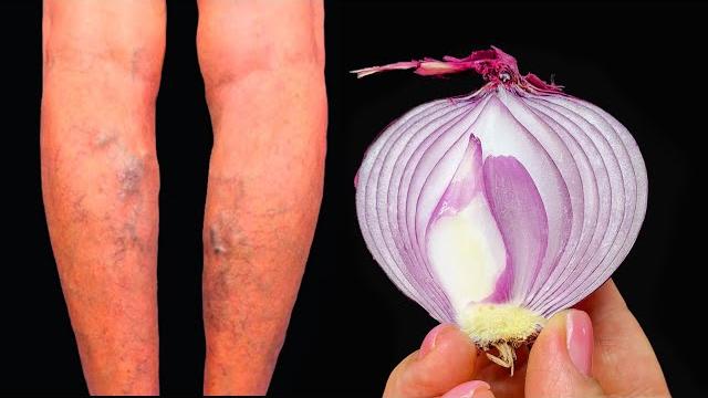 Unbelievable! it's a varicose vein killer! erases varicose veins like an eraser!2 recipes Unbelievable! it's a varicose vein killer! erases varicose veins like an eraser!2 recipes