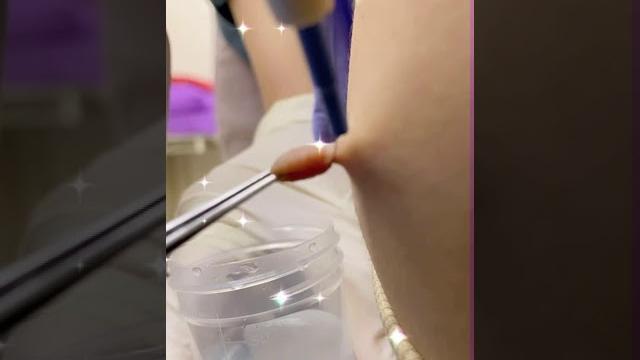 Laser kutil zasss kejap siap - story @drmanttdi Laser kutil zasss kejap siap - story @drmanttdi