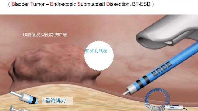 【bt-esd】水刀膀胱癌剝離術 【bt-esd】水刀膀胱癌剝離術