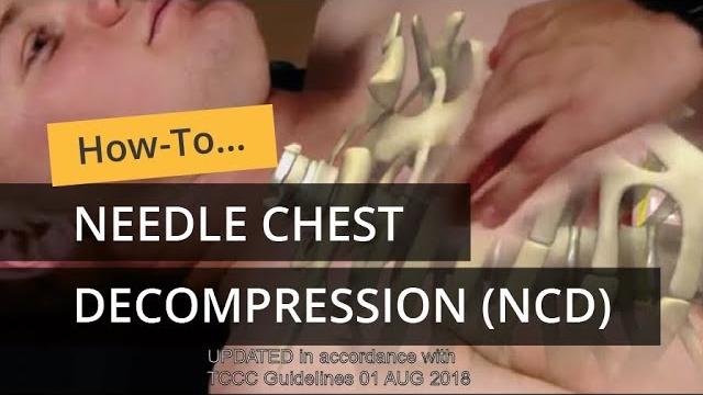 Needle chest decompression in tccc Needle chest decompression in tccc