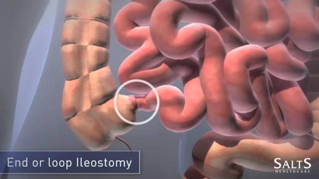What is an ileostomy? What is an ileostomy?