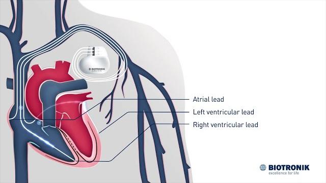 Cardiac resynchronization therapy – how it works Cardiac resynchronization therapy – how it works