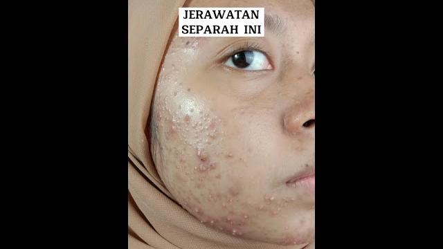 Awas jijik,, jerawatan parah sembuh Awas jijik,, jerawatan parah sembuh