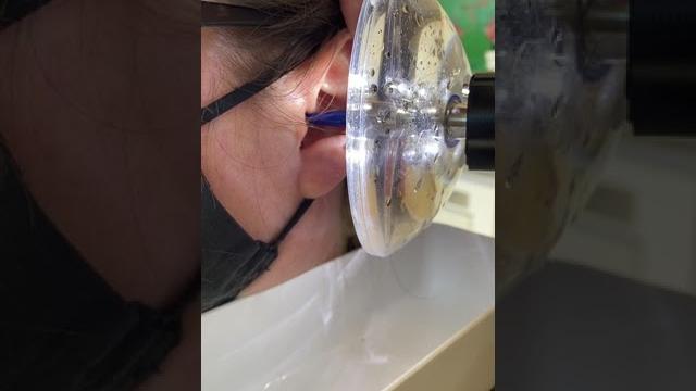 Removing ear wax using the earigator™ at hearing healthcare centers, broomfield, co Removing ear wax using the earigator™ at hearing healthcare centers, broomfield, co