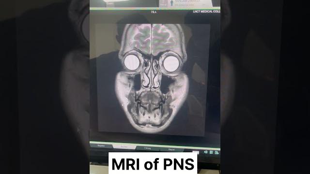 Mri of pns#support #viral #suscribe #xray #radiology #youtubeshort #viralvideo #trending #motivation Mri of pns#support #viral #suscribe #xray #radiology #youtubeshort #viralvideo #trending #motivation