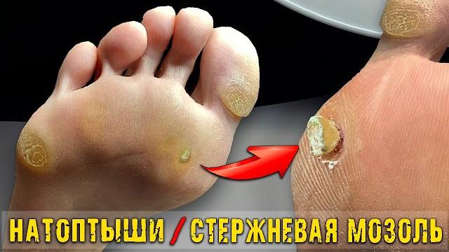 Педикюр столовыми приборами?! стержневая мозоль от гвоздя . глубокая мозоль. педикюр.massive corn Педикюр столовыми приборами?! стержневая мозоль от гвоздя . глубокая мозоль. педикюр.massive corn