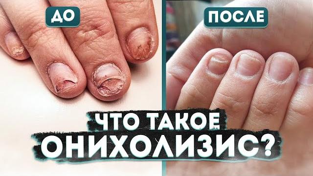 Онихолизис. что это такое и как его лечить? | мнение подолога | лечение | диагностика | профилактика Онихолизис. что это такое и как его лечить? | мнение подолога | лечение | диагностика | профилактика