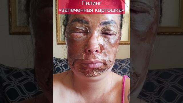 Супер омоложение -феноловый пилинг дает потрясающие результаты ! #пилинг #омоложение #косметология Супер омоложение -феноловый пилинг дает потрясающие результаты ! #пилинг #омоложение #косметология
