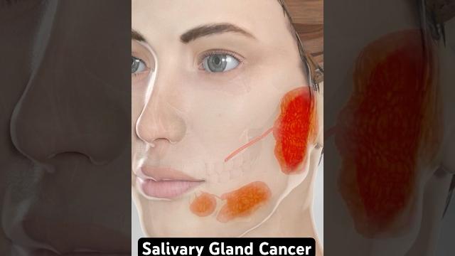 Cancer in your salivary glands (3d animation) Cancer in your salivary glands (3d animation)