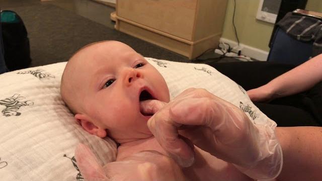 Gentle post-frenotomy care and mouth work by melissa cole, ms, ibclc of luna lactation & wellness Gentle post-frenotomy care and mouth work by melissa cole, ms, ibclc of luna lactation & wellness