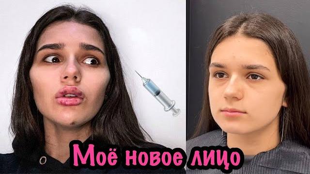 Накачала лицо | что я с собой сделала Накачала лицо | что я с собой сделала