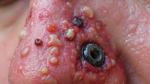 Best pimple pops of 2025 | satisfying, relaxing, blackheads, cysts, acne remover videos 2 Best pimple pops of 2025 | satisfying, relaxing, blackheads, cysts, acne remover videos 2