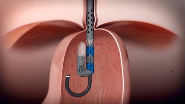 Incisionless reflux surgery - esophyx transoral incisionless fundoplication (tif procedure) Incisionless reflux surgery - esophyx transoral incisionless fundoplication (tif procedure)