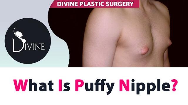 What is puffy nipple in gynecomastia? What is puffy nipple in gynecomastia?
