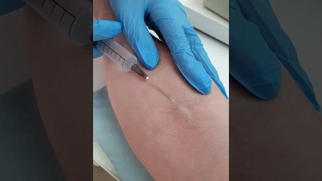 Внутривенно первый раз, учимся. Внутривенно первый раз, учимся.