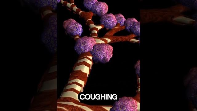 What happens during an asthma attack?🫁#asthma #asthmaattack #3danimation #healtheducation #shorts What happens during an asthma attack?🫁#asthma #asthmaattack #3danimation #healtheducation #shorts