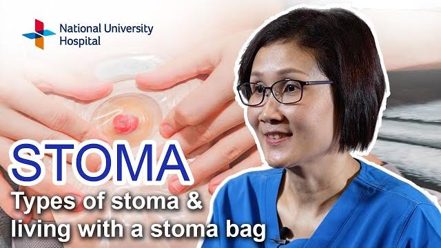 Stoma – types of stoma and living with a stoma bag Stoma – types of stoma and living with a stoma bag