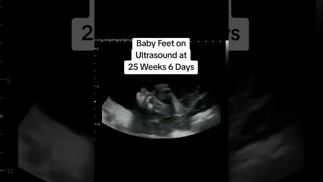 Baby feet & toes on ultrasound at 25 weeks 6 days pregnant! #heybabymobile #babyfeet #babytoes #baby Baby feet & toes on ultrasound at 25 weeks 6 days pregnant! #heybabymobile #babyfeet #babytoes #baby