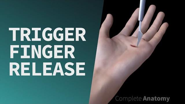 Trigger finger release Trigger finger release
