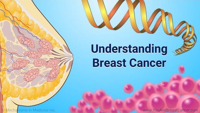 Understanding breast cancer Understanding breast cancer