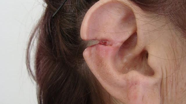 Ear defect repair // как правильно зашить ухо Ear defect repair // как правильно зашить ухо