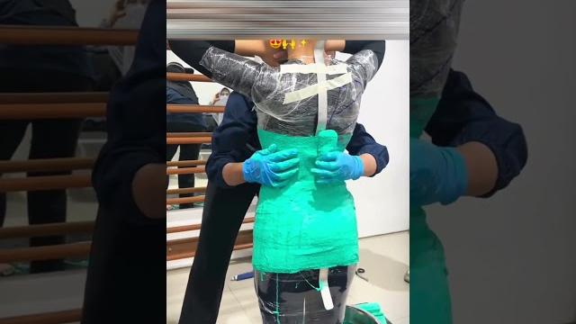 Scoliosis Scoliosis