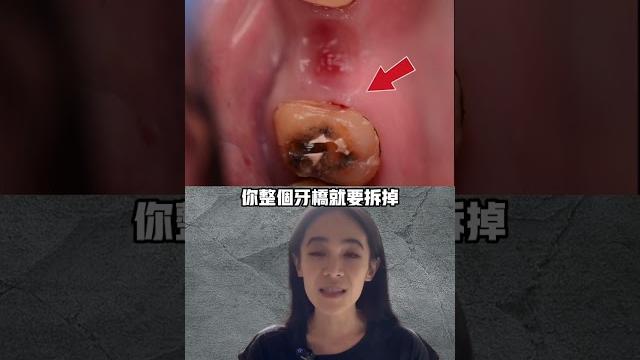 壞一顆牙損失三顆牙#牙橋#拆假牙#假牙蛀牙 壞一顆牙損失三顆牙#牙橋#拆假牙#假牙蛀牙