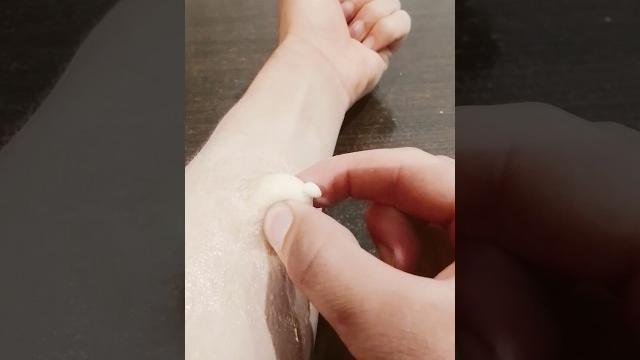 Огромный фурункул #tiktok Огромный фурункул #tiktok