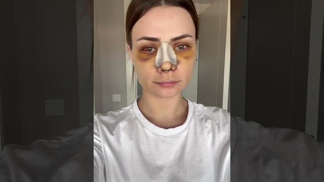 Burun ameliyatı olmak isteyenleri görelim Burun ameliyatı olmak isteyenleri görelim