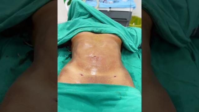 Abdomen liposuction immediate result #shorts Abdomen liposuction immediate result #shorts