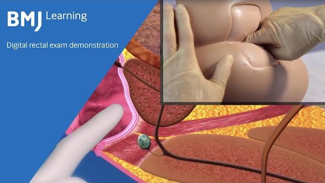 Digital rectal exam demonstration from bmj learning Digital rectal exam demonstration from bmj learning