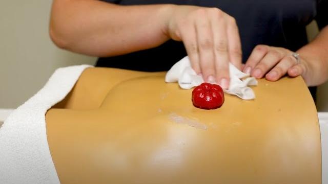 How to treat skin irritation around your stoma How to treat skin irritation around your stoma