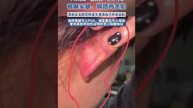千萬網紅“田姥姥”外孫可心被曝家暴、腳踏兩條船,其前女友歐尼熊發文澄清自己并未出軌,自稱曾被可心pua,被家暴后可心母親曾勸其放棄驗傷證明并簽訂和解協議(津云)#可心 #歐尼熊 千萬網紅“田姥姥”外孫可心被曝家暴、腳踏兩條船,其前女友歐尼熊發文澄清自己并未出軌,自稱曾被可心pua,被家暴后可心母親曾勸其放棄驗傷證明并簽訂和解協議(津云)#可心 #歐尼熊