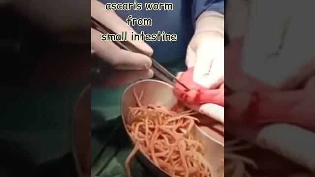 Ascaris worm from small intestine | tarang academy Ascaris worm from small intestine | tarang academy
