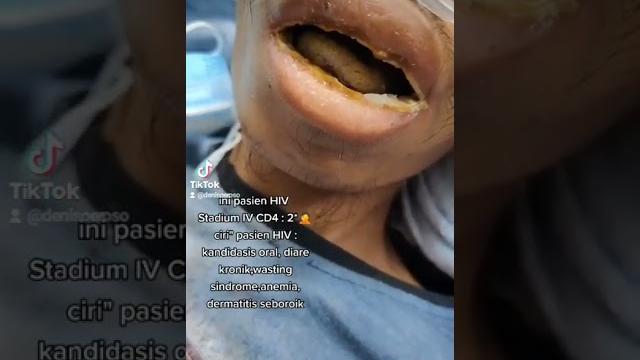 Pasien hiv aids dengan cd4 : 2 dengan kandidiasis oral Pasien hiv aids dengan cd4 : 2 dengan kandidiasis oral