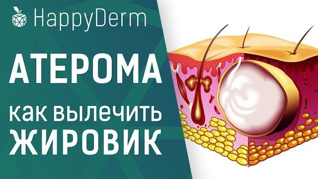 Атерома — что это такое, в чём отличие от липомы, опасен ли жировик на теле и как удалить атерому Атерома — что это такое, в чём отличие от липомы, опасен ли жировик на теле и как удалить атерому