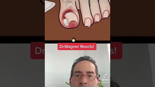 Asmr ingrown toenail removal #shorts #asmr #ingrowntoenail Asmr ingrown toenail removal #shorts #asmr #ingrowntoenail