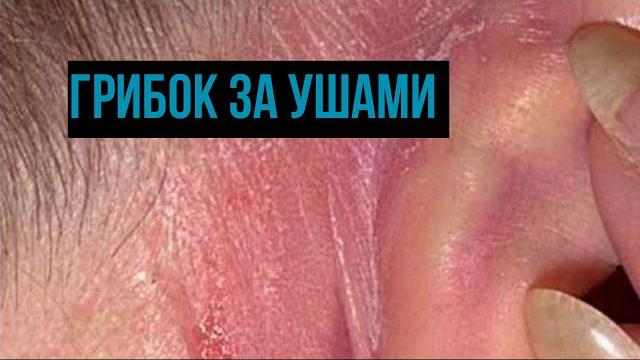 Грибок за ушами: лечение у взрослых и детей Грибок за ушами: лечение у взрослых и детей