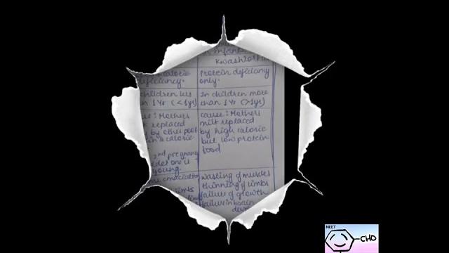 (pem) protein energy malnutrition-marasmus & kwashiorkar|digestion & absorption|biology|ncert|neet| (pem) protein energy malnutrition-marasmus & kwashiorkar|digestion & absorption|biology|ncert|neet|