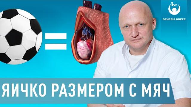 Гидроцеле. водянка яичка. яичко размером с футбольный мяч.| случай из практики хирурга шевцова Гидроцеле. водянка яичка. яичко размером с футбольный мяч.| случай из практики хирурга шевцова