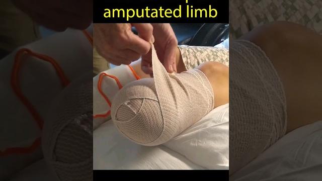 How to wrap a stump #amputation #amputee How to wrap a stump #amputation #amputee