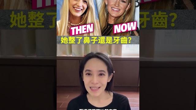 女神的笑容是這樣養成,戴牙套後加切牙齦手術。布蕾克萊芙莉,死侍老婆的進化之路|林榆芩醫師 女神的笑容是這樣養成,戴牙套後加切牙齦手術。布蕾克萊芙莉,死侍老婆的進化之路|林榆芩醫師