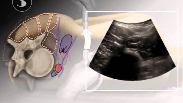 Psoas compartment nerve block Psoas compartment nerve block