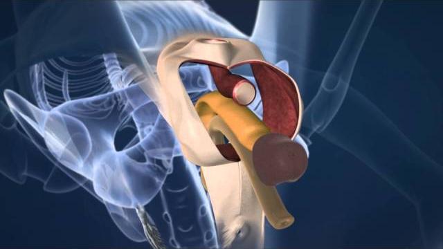 Sex reassignment male to female surgery Sex reassignment male to female surgery