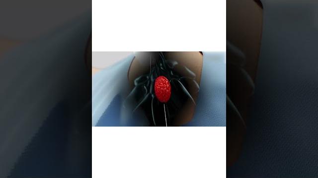 Non-surgical removal of breast fibroadenoma | breast lump treatment without surgery | dr. gaurav g. Non-surgical removal of breast fibroadenoma | breast lump treatment without surgery | dr. gaurav g.